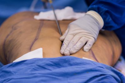 lipo ab etching can be more painful than regular liposuction